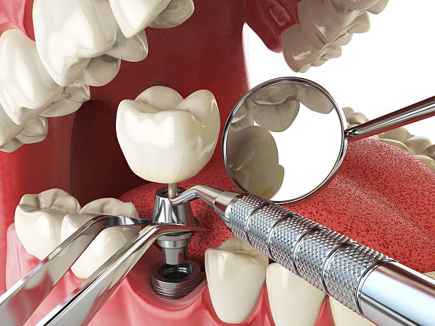 Best Emergency Tooth Extraction in Northlake, IL