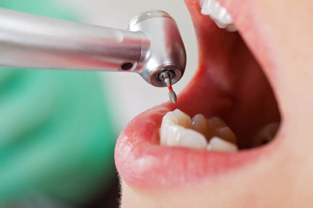 Best Emergency Treatment for Dental Infections or Abscesses in Northlake, IL